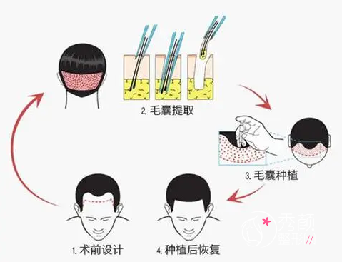 上海植发医院哪家好，上海植发医院排名前十看看哪些植发机构上榜了