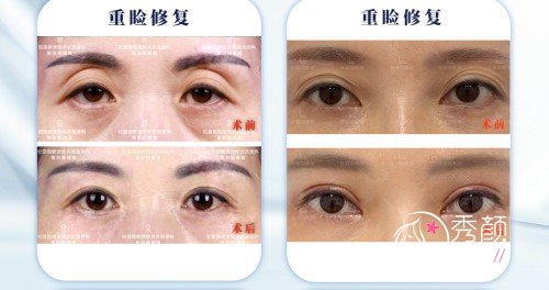 上海爱尚丽格杜园园双眼皮修复怎么样，贵不贵？附双眼皮修复案例