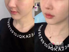 法令纹的改良思路功课