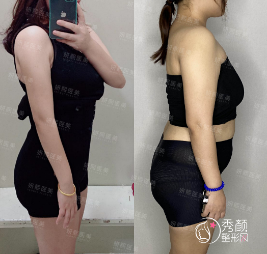 深圳妍熙李静吸脂怎么样,附腰腹吸脂+手臂吸脂案例