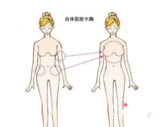 自体脂肪填充丰胸多少钱，可以保持多少年？
