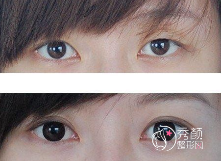成都华欣美辰医疗美容医院做双眼皮怎么样?附双眼皮案例以及价格表