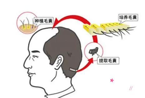 石家庄省二院植发怎么样，多少钱一个毛囊？附植发价格表一览