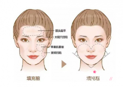 上海脂肪填充整形医院哪个好？上海华美vs上海美莱vs上海伊莱美