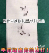 颧骨内推钛钉取好还是不取好？