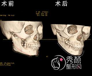 重庆松山医院朱乐林磨骨怎么样，有没有失败案例？附朱乐林磨骨案例