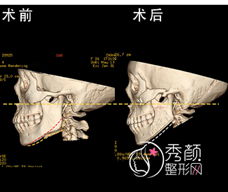 重庆松山医院朱乐林磨骨怎么样，有没有失败案例？附朱乐林磨骨案例
