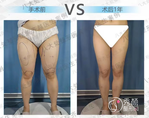 北京八大处齐越吸脂怎么样,多少钱?附吸脂案例及价格表一览