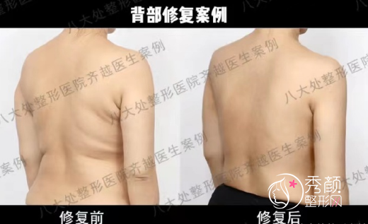 北京八大处齐越吸脂怎么样,多少钱?附吸脂案例及价格表一览