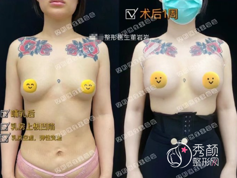 北京嘉禾妇儿医院董岩岩隆胸怎么样，多少钱？附董岩岩假体隆胸案例