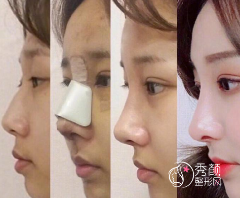 重庆西南医院王量隆鼻怎么样，多少钱？附隆鼻案例