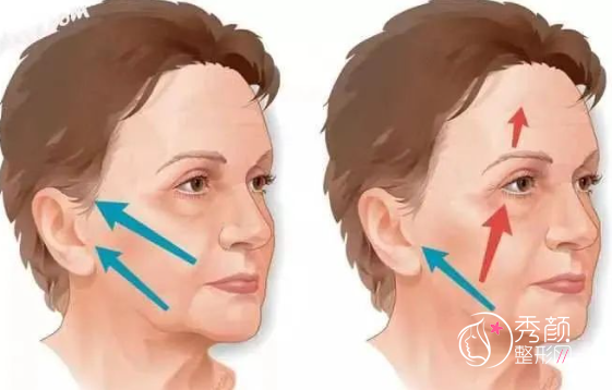 杜太超拉皮怎么样？收费贵不贵？有没有失败案例？