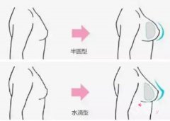 隆胸假体选圆形还是水滴