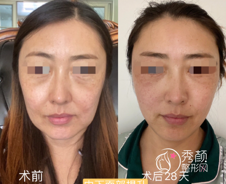 谢洋春做拉皮手术怎么样?收费贵不贵?附拉皮手术案例