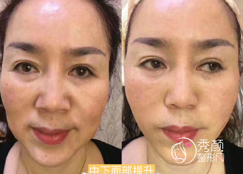 谢洋春做拉皮手术怎么样?收费贵不贵?附拉皮手术案例