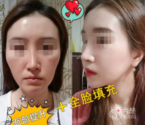 全脸脂肪填充要花多少钱