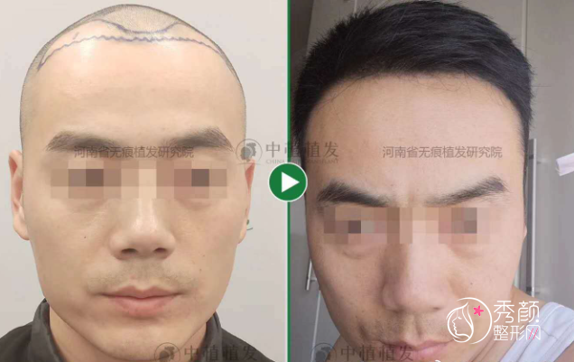 郑州中植植发医院植发效果怎么样？附植发案例及植发价格表一览