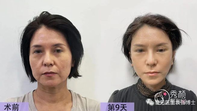 北京市第六医院袁强拉皮手术怎么样？是包装出来的吗？附拉皮手术案例
