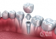 深圳公立医院种植牙价格是多少？贵不贵？附2023种植牙价格表一览