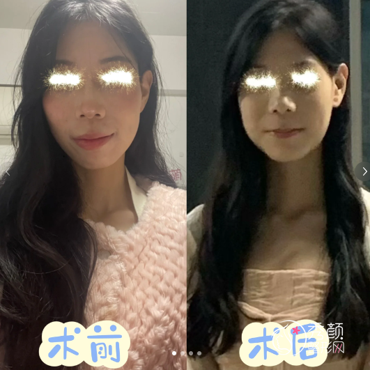 武汉大学口腔医院正颌手术多少钱？效果好不好？附正颌手术真实案例
