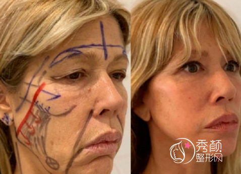 拉皮手术一般需要多少钱？国内做拉皮手术好的医院医生盘点！