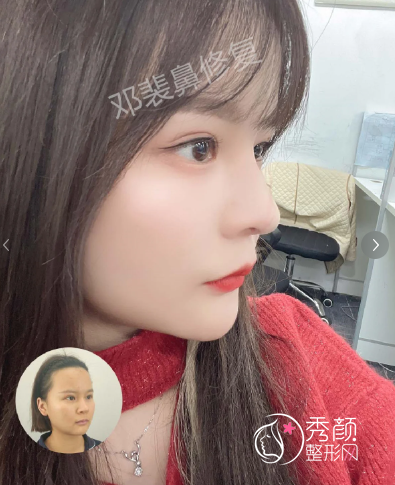 武汉同济医院曾宁和邓裴隆鼻哪个好?附真实隆鼻案例对比