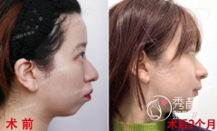 上海时光何晋龙正颌手术怎么样？多少钱？附正颌手术真实案例