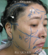 聂云飞做拉皮手术做得好吗？从拉皮手术真实案例来看聂云飞的技术！