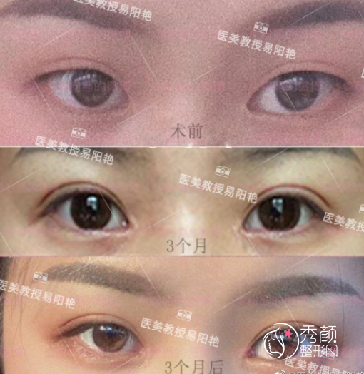 南昌二附院易阳艳割双眼皮怎么样?附双眼皮开眼角真实案例