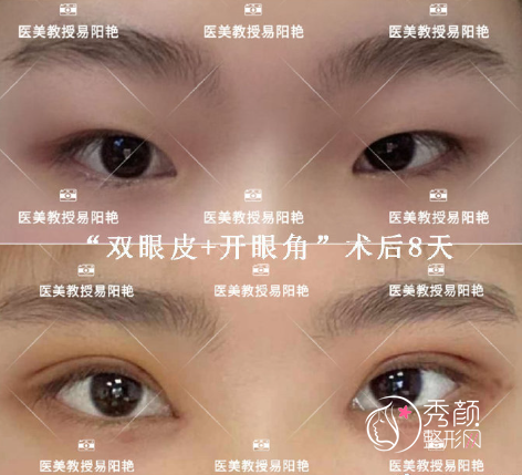 南昌二附院易阳艳割双眼皮怎么样?附双眼皮开眼角真实案例