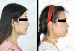 李继华和罗恩做凸嘴正颌手术谁厉害？案例技术对比