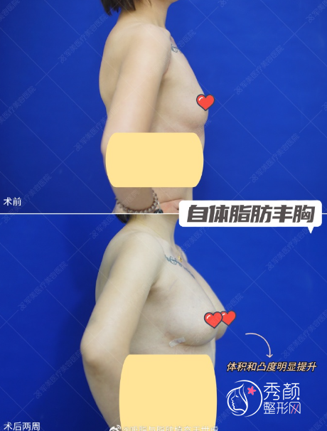 广州军美王世虎自体脂肪隆胸怎么样，有没有失败案例？附隆胸案例