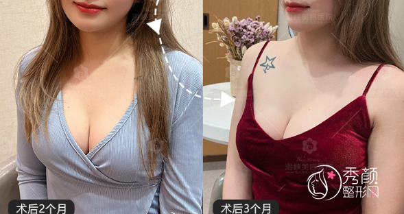 福州海峡林沸腾隆胸多少钱，技术怎么样？附隆胸真实案例