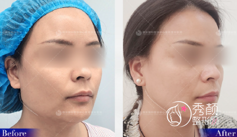 西安改脸型医生籍建华下颌角磨骨怎么样，有没有失败案例？