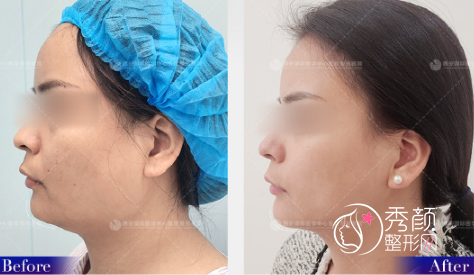 西安改脸型医生籍建华下颌角磨骨怎么样，有没有失败案例？