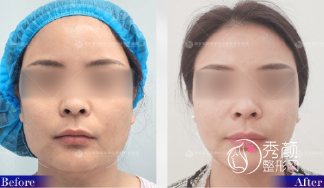 西安改脸型医生籍建华下颌角磨骨怎么样，有没有失败案例？