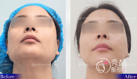西安改脸型医生籍建华下颌角磨骨怎么样，有没有失败案例？