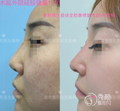 西安美莱医院曾熬医生隆鼻怎么样，有没有失败案例？