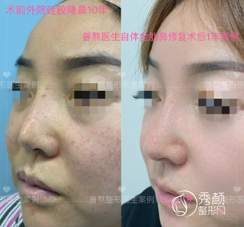 西安美莱医院曾熬医生隆鼻怎么样，有没有失败案例？