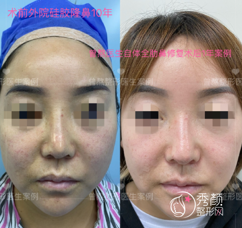 西安美莱医院曾熬医生隆鼻怎么样，有没有失败案例？