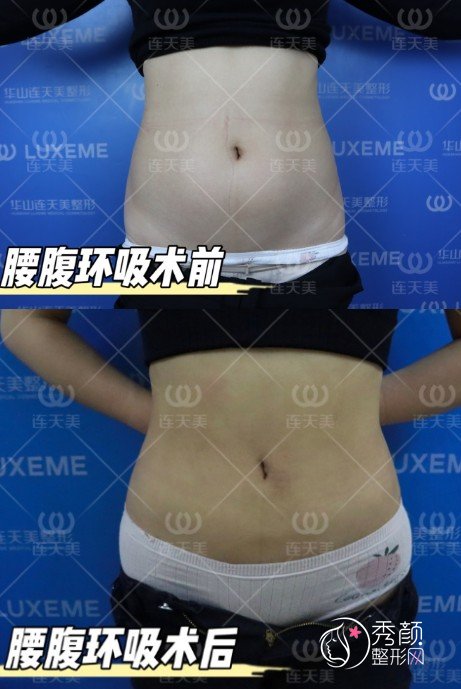 杭州连天美李文鹏吸脂怎么样，有没有失败案例？附腰腹环吸案例