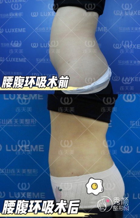 杭州连天美李文鹏吸脂怎么样，有没有失败案例？附腰腹环吸案例