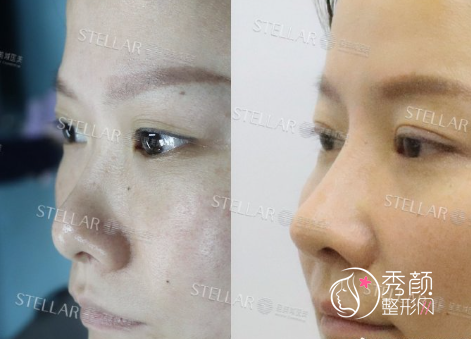 长沙星美域医疗美容付腾鹏隆鼻怎么样？附真实隆鼻案例