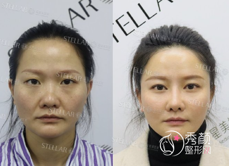 长沙星美域医疗美容付腾鹏隆鼻怎么样？附真实隆鼻案例