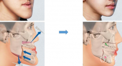 广州正颌医生哪个好？盘