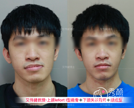 广东省口腔医院艾伟健医生正颌手术怎么样？附正颌手术案例