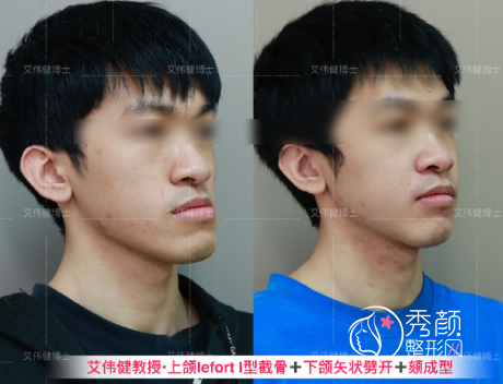 广东省口腔医院艾伟健医生正颌手术怎么样？附正颌手术案例