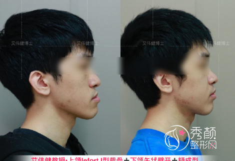 广东省口腔医院艾伟健医生正颌手术怎么样？附正颌手术案例