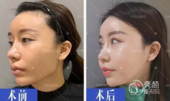 付国友磨骨怎么样？从付国友磨骨案例来看看技术到底怎么样吧！