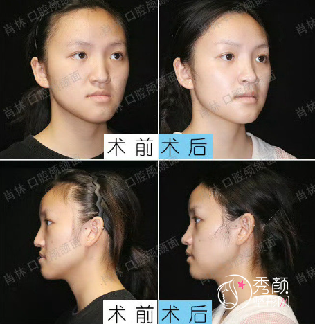 重庆松山医院做正颌手术好吗？肖林和王涛哪个医生好呢？